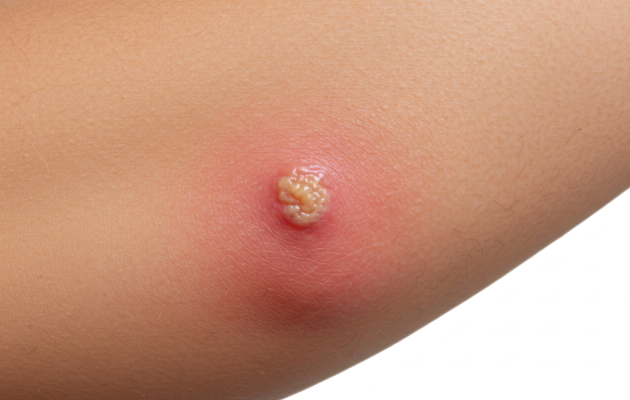 Контагиозный моллюск у взрослых