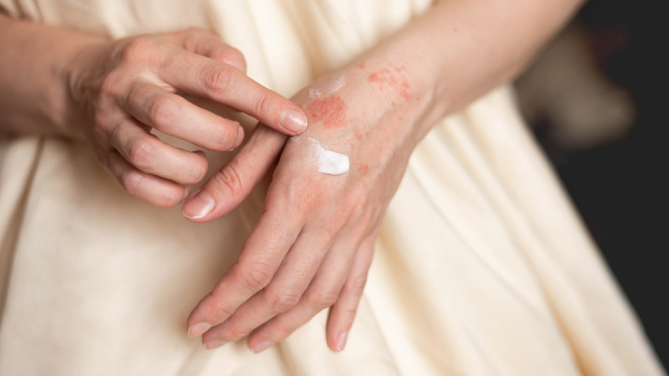 Причины псориаза у женщин и мужчин