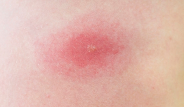 Как выглядит укус клеща