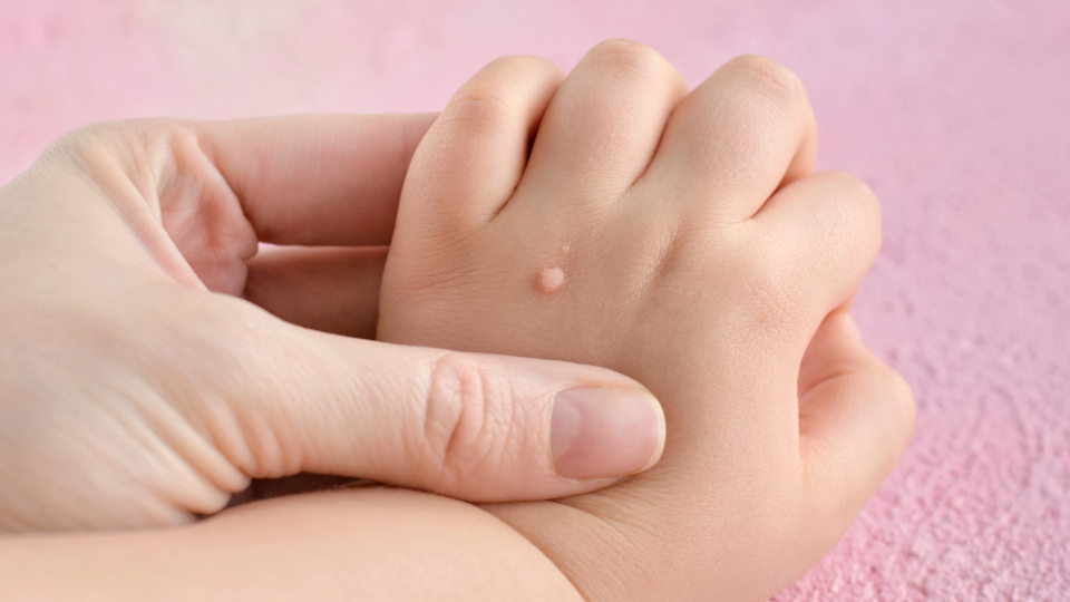 Лучшие способы лечения бородавок у детей